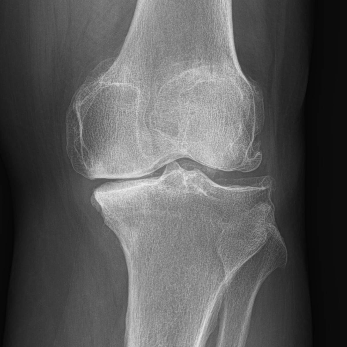 arhtrose du genou : radiographie