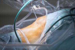 Qu'est-ce que l'arthroscopie ? - Dr Philippe LORIAUT | Chirurgien Orthopdiste Paris Qu'est-ce que l'arthroscopie ? - Dr Philippe LORIAUT | Chirurgien Orthopdiste Paris