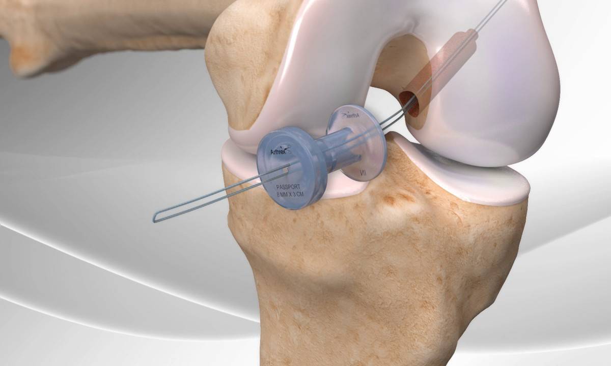 Opération du ligament croisé antérieur du genou (LCA) Questions ...