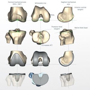 planification en 3D de l'implant et des guides de coupe personnalisés