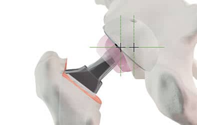 https://www.chirurgienorthopedisteparis.com/wp-content/uploads/2021/01/arthrose-quelles-solutions.jpg prothèse de hanche