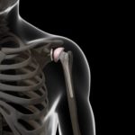 prothèse totale d’épaule prothèse totale d'épaule