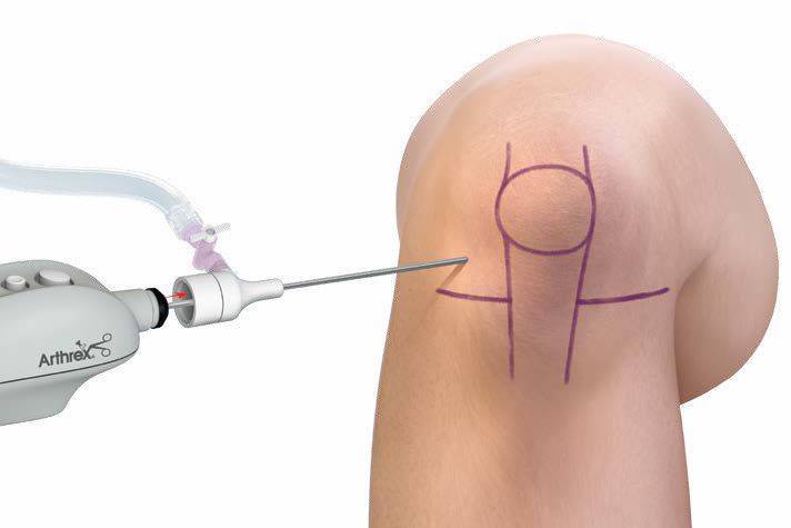chirurgie du genou avec le NanoScope