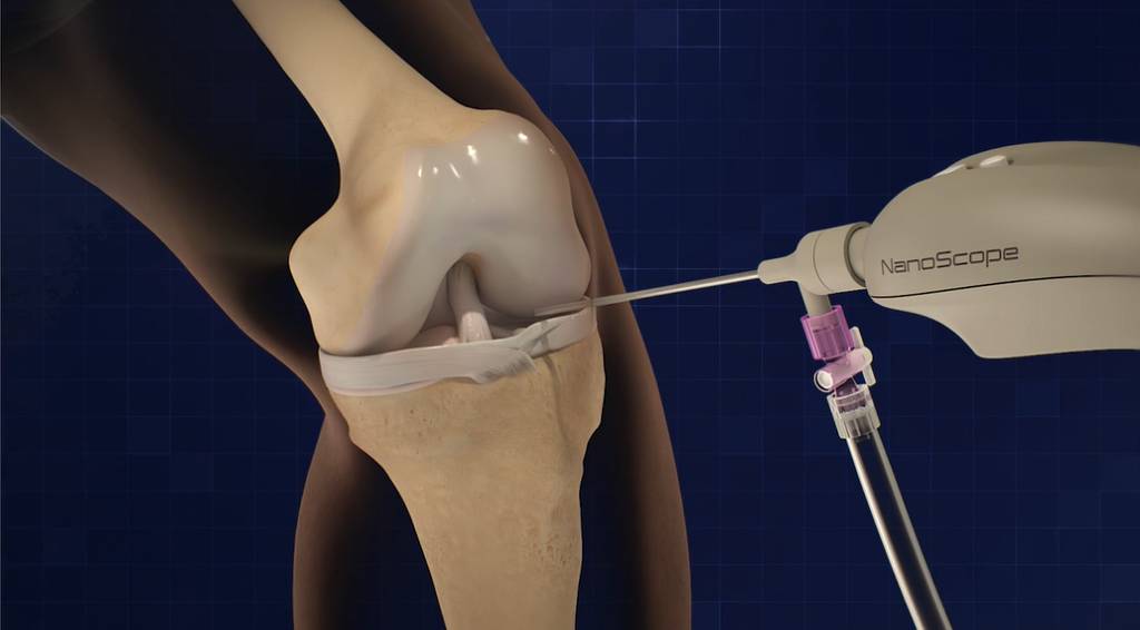nanoscope : opération des ligaments du genou